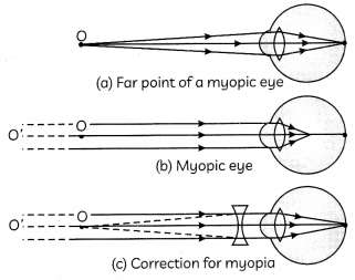 Defects-of-Vision-1